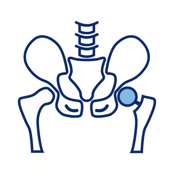 Hip Replacement Surgery