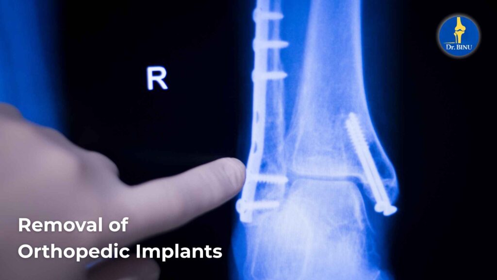 Removal Of Orthopedic implants