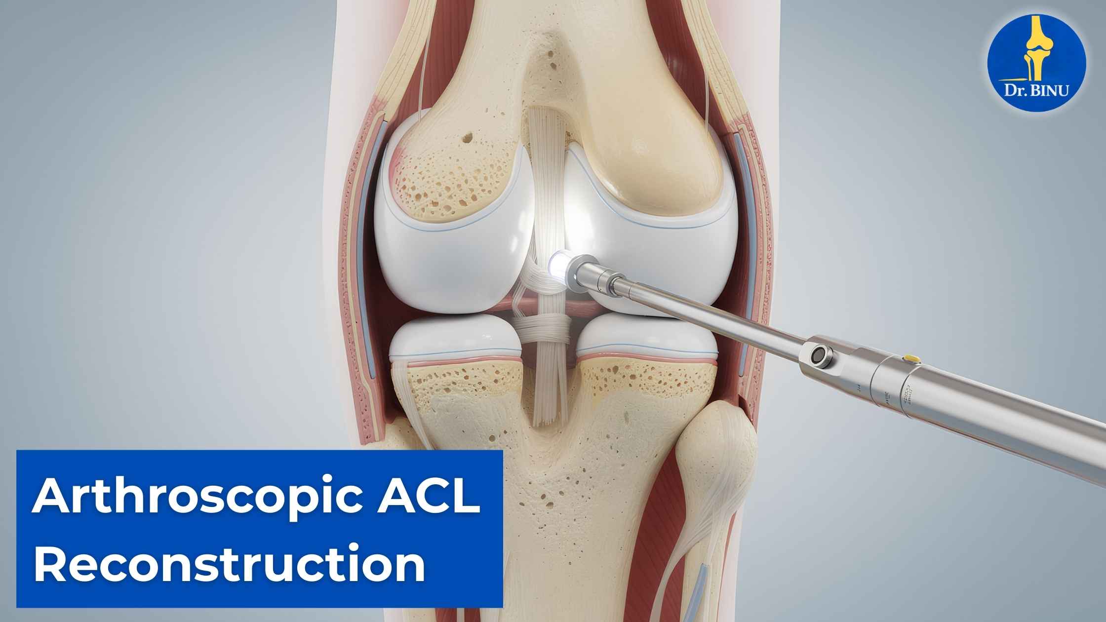 Arthroscopic Acl Reconstruction Steps