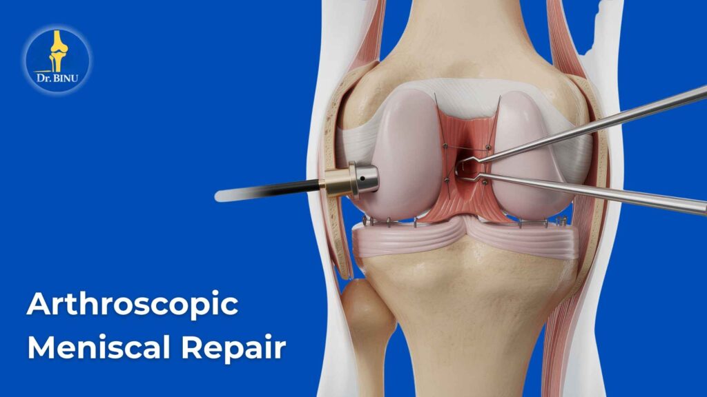 Arthoscopic Meniscal Repair